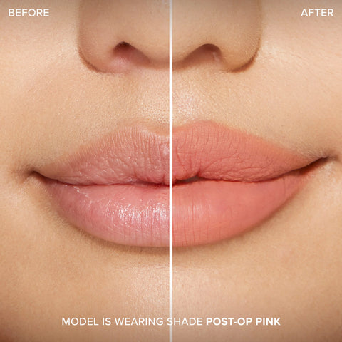 Lip Injection Extreme Lip Shaper